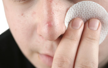 Dealing with acne cysts