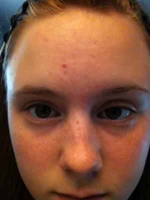 My Forehead :\ My eyes look funny...