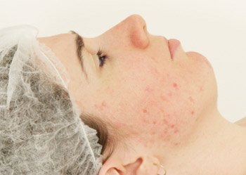 How to get rid of acne scars How to get rid of acne scars