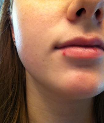 The one on my lip