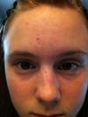 My Forehead :\ My eyes look funny...